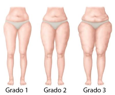 tipos de lipedema
