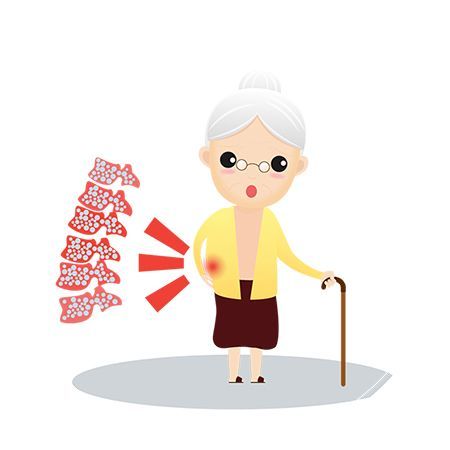 dona gran osteoporosi